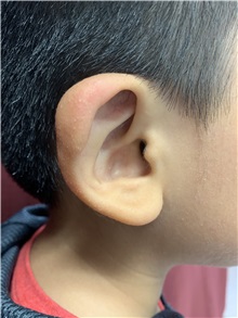 Ear Surgery Before Photo by M. Zakir Sabry, MD; New York, NY - Case 50787