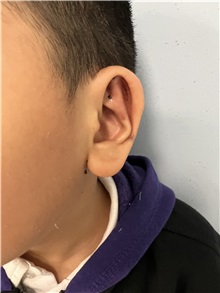 Ear Surgery After Photo by M. Zakir Sabry, MD; New York, NY - Case 50787