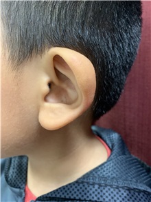 Ear Surgery Before Photo by M. Zakir Sabry, MD; New York, NY - Case 50787