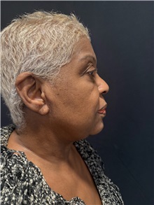 Body Lift After Photo by M. Zakir Sabry, MD; New York, NY - Case 50786