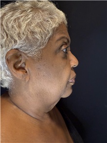 Body Lift Before Photo by M. Zakir Sabry, MD; New York, NY - Case 50786