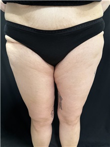 Thigh Lift After Photo by M. Zakir Sabry, MD; New York, NY - Case 50784
