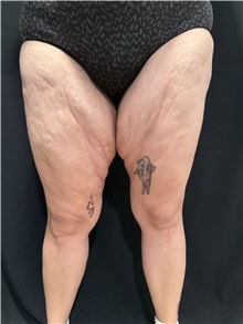 Thigh Lift Before Photo by M. Zakir Sabry, MD; New York, NY - Case 50784