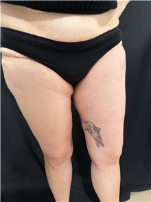 Thigh Lift After Photo by M. Zakir Sabry, MD; New York, NY - Case 50784