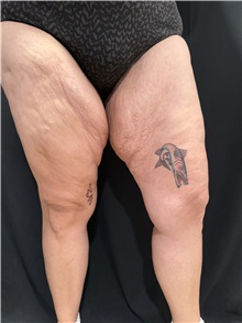 Thigh Lift Before Photo by M. Zakir Sabry, MD; New York, NY - Case 50784