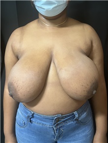 Breast Reduction Before Photo by M. Zakir Sabry, MD; New York, NY - Case 50789