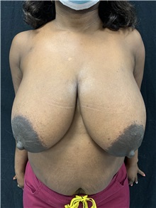 Breast Reduction Before Photo by M. Zakir Sabry, MD; New York, NY - Case 50790