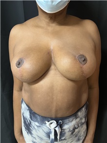 Breast Reduction After Photo by M. Zakir Sabry, MD; New York, NY - Case 50788