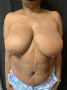 Breast Reduction Before Photo by M. Zakir Sabry, MD; New York, NY - Case 50788