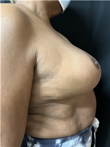Breast Reduction After Photo by M. Zakir Sabry, MD; New York, NY - Case 50788