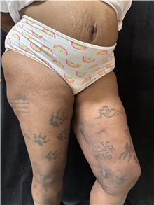 Thigh Lift After Photo by M. Zakir Sabry, MD; New York, NY - Case 50795