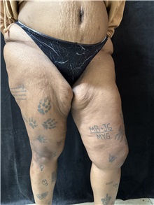 Thigh Lift Before Photo by M. Zakir Sabry, MD; New York, NY - Case 50795