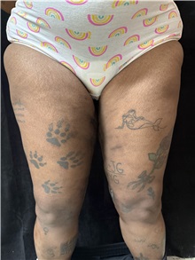 Thigh Lift After Photo by M. Zakir Sabry, MD; New York, NY - Case 50795