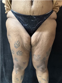 Thigh Lift Before Photo by M. Zakir Sabry, MD; New York, NY - Case 50795