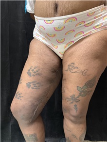 Thigh Lift After Photo by M. Zakir Sabry, MD; New York, NY - Case 50795