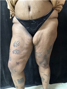 Thigh Lift Before Photo by M. Zakir Sabry, MD; New York, NY - Case 50795