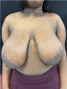 Breast Reduction Before Photo by M. Zakir Sabry, MD; New York, NY - Case 50797