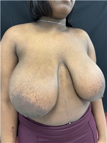 Breast Reduction Before Photo by M. Zakir Sabry, MD; New York, NY - Case 50797