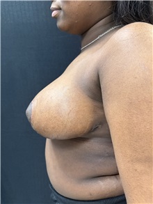 Breast Reduction After Photo by M. Zakir Sabry, MD; New York, NY - Case 50797