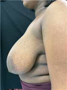 Breast Reduction Before Photo by M. Zakir Sabry, MD; New York, NY - Case 50797