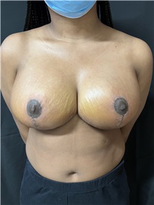 Breast Reduction After Photo by M. Zakir Sabry, MD; New York, NY - Case 50796