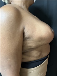 Breast Reduction After Photo by M. Zakir Sabry, MD; New York, NY - Case 50803