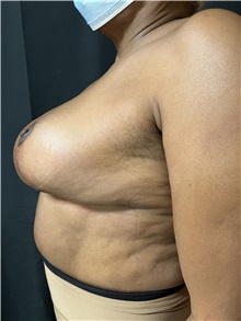 Breast Reduction After Photo by M. Zakir Sabry, MD; New York, NY - Case 50803