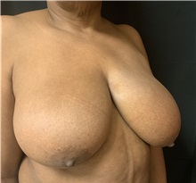 Breast Reduction Before Photo by M. Zakir Sabry, MD; New York, NY - Case 50803