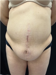Tummy Tuck Before Photo by M. Zakir Sabry, MD; New York, NY - Case 50806