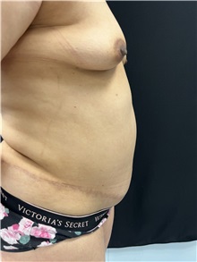 Tummy Tuck After Photo by M. Zakir Sabry, MD; New York, NY - Case 50806