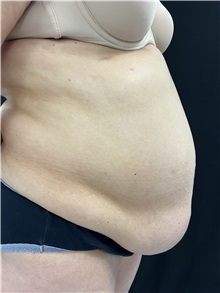 Tummy Tuck Before Photo by M. Zakir Sabry, MD; New York, NY - Case 50806