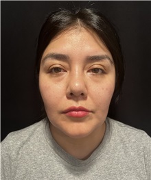 Rhinoplasty After Photo by M. Zakir Sabry, MD; New York, NY - Case 50808