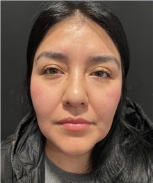 Rhinoplasty Before Photo by M. Zakir Sabry, MD; New York, NY - Case 50808