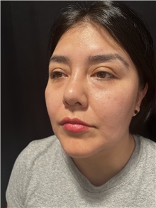 Rhinoplasty After Photo by M. Zakir Sabry, MD; New York, NY - Case 50808