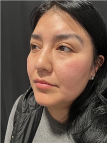 Rhinoplasty Before Photo by M. Zakir Sabry, MD; New York, NY - Case 50808