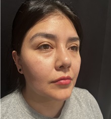 Rhinoplasty After Photo by M. Zakir Sabry, MD; New York, NY - Case 50808