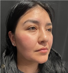 Rhinoplasty Before Photo by M. Zakir Sabry, MD; New York, NY - Case 50808