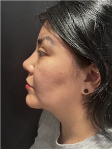 Rhinoplasty After Photo by M. Zakir Sabry, MD; New York, NY - Case 50808