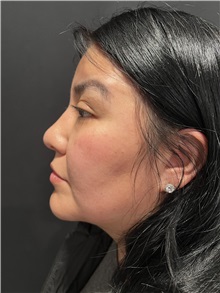 Rhinoplasty Before Photo by M. Zakir Sabry, MD; New York, NY - Case 50808