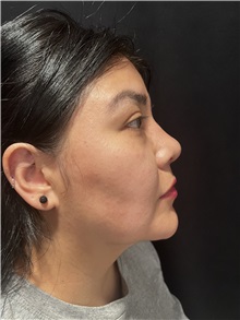Rhinoplasty After Photo by M. Zakir Sabry, MD; New York, NY - Case 50808