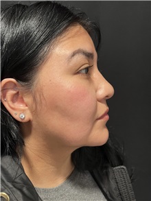 Rhinoplasty Before Photo by M. Zakir Sabry, MD; New York, NY - Case 50808