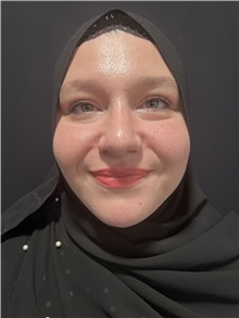 Rhinoplasty After Photo by M. Zakir Sabry, MD; New York, NY - Case 50807