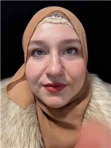 Rhinoplasty Before Photo by M. Zakir Sabry, MD; New York, NY - Case 50807