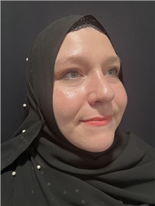 Rhinoplasty After Photo by M. Zakir Sabry, MD; New York, NY - Case 50807