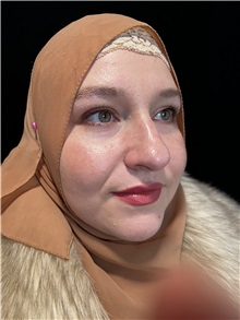 Rhinoplasty Before Photo by M. Zakir Sabry, MD; New York, NY - Case 50807