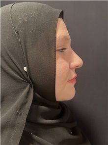 Rhinoplasty After Photo by M. Zakir Sabry, MD; New York, NY - Case 50807