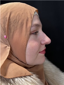 Rhinoplasty Before Photo by M. Zakir Sabry, MD; New York, NY - Case 50807