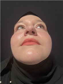 Rhinoplasty After Photo by M. Zakir Sabry, MD; New York, NY - Case 50807