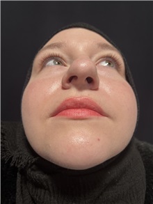 Rhinoplasty Before Photo by M. Zakir Sabry, MD; New York, NY - Case 50807