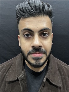 Deviated Septum Correction After Photo by M. Zakir Sabry, MD; New York, NY - Case 50809